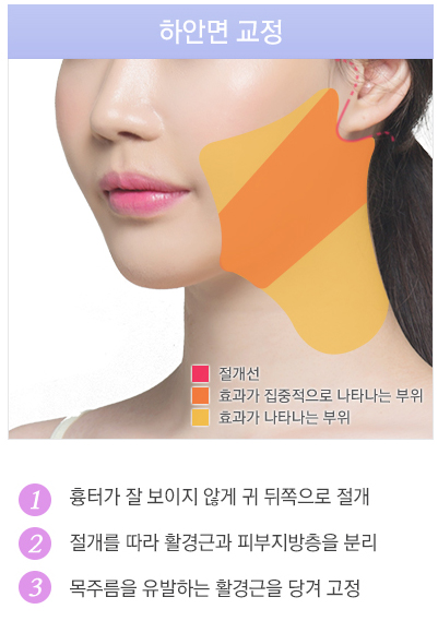 뼈 수술 없이 매끄러운 브이라인얼굴! JW정원성형외과 윤곽교정 관련 이미지 6