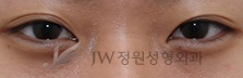 밝고 맑은 인상으로 변신, 눈밑지방재배치! JW정원성형외과에서~ 관련 이미지 2