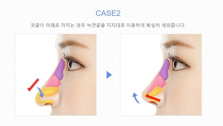 재수술 없는 JW정원성형외과 늑연골 코성형 관련 이미지 4