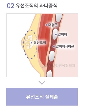 남모를 고민 여성형유방(여유증), JW정원성형외과 여성형유방 수술로 고민해결! 관련 이미지 4