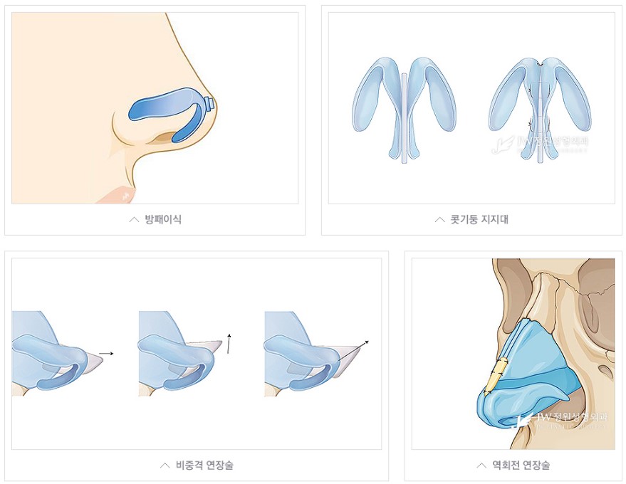 코끝에서 완성되는 아름다움, JW정원성형외과 코끝성형 관련 이미지 5
