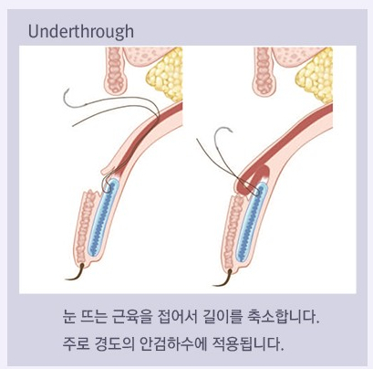 Ptosis Double Eyelid Surgery: Different Eye-Correction Methods Depending on the Degree image 4