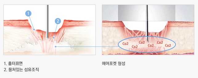 흉터? 주름? JW정원성형외과 엑스카로 말끔하게! 관련 이미지 2