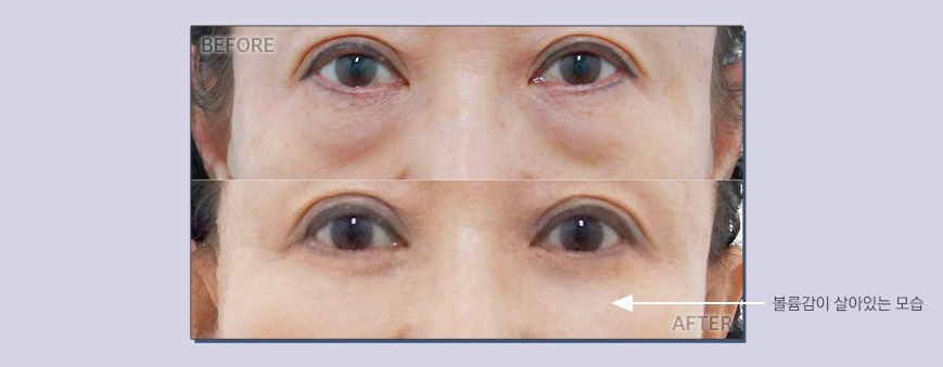 JW Garden Lower Blepharoplasty to Meet the Younger Me Again image 4