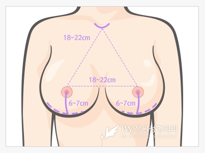 안전하고 정확한 맞춤 가슴성형, JW정원성형외과 HD내시경 가슴확대 관련 이미지 6