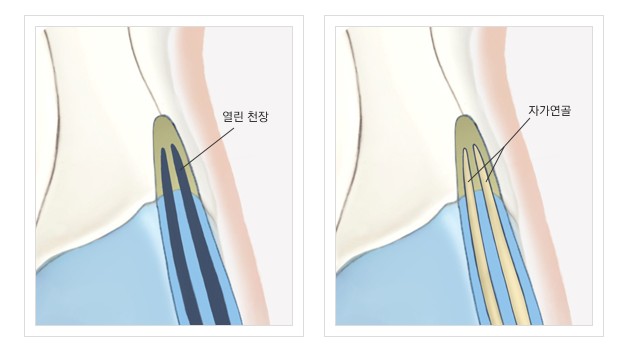 Hump Nose Diagnosis, for a More Natural Appearance image 5