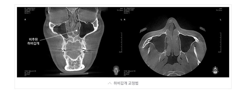 [JW정원성형외과] 코성형과 함께하는 비중격만곡증 및 비염수술 관련 이미지 5