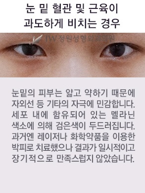 울퉁불퉁한 눈 밑, 피곤해 보이는 눈 밑 JW정원 눈밑지방재배치로 고민 해결! 관련 이미지 3