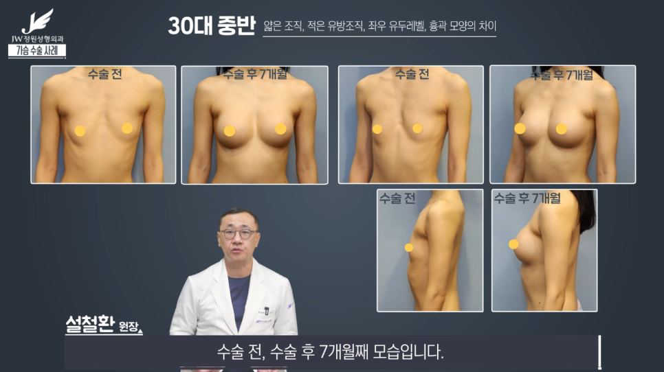 가슴성형수술전후 개인별 맞춤으로 꼼꼼하게! 【강남 JW정원성형외과】 관련 이미지 7