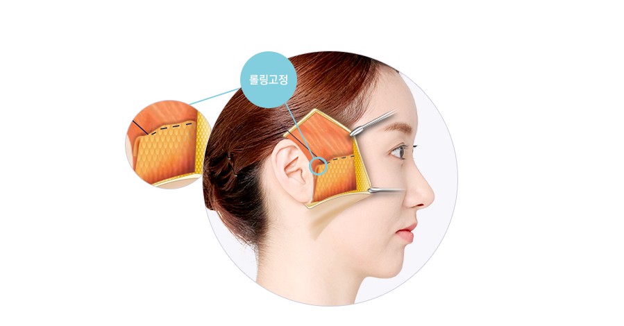 미니거상과 전체 안면거상, 나에게 맞는 안면거상술은? 관련 이미지 6