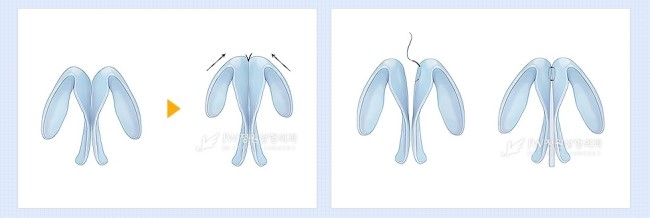 세련되고 아름다운 코라인! JW정원성형외과 복코교정으로 관련 이미지 6