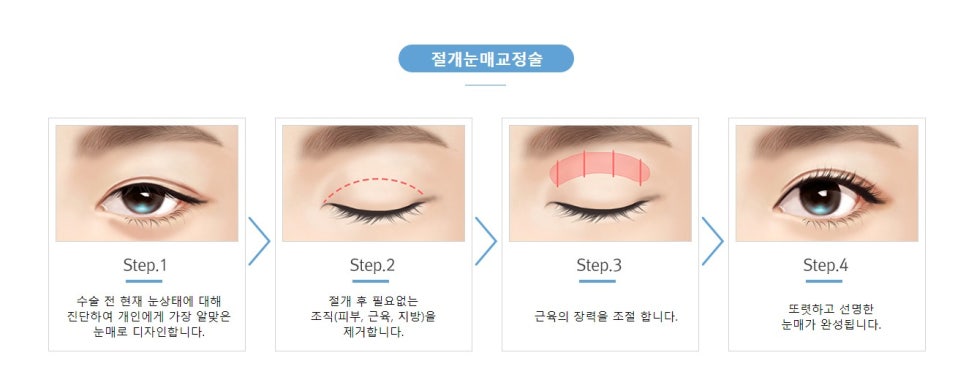 절개/비절개눈매교정, 나에게 맞는 눈매교정술은? 관련 이미지 4