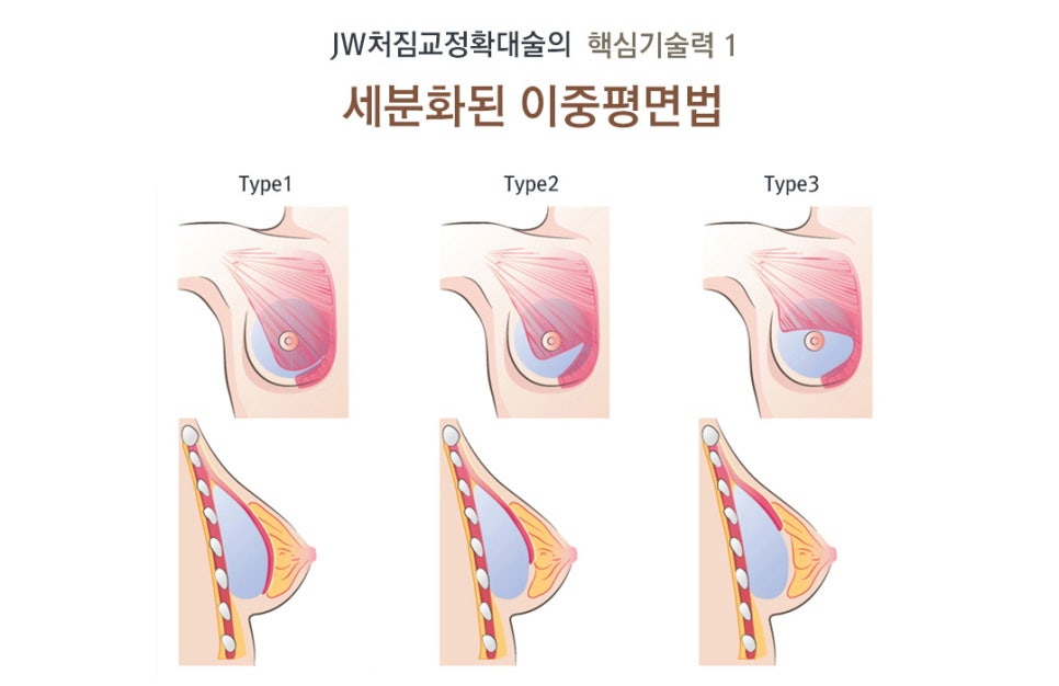 처진정도, 높이, 위치, 비대칭 등을 고려한 JW 처진가슴수술 관련 이미지 4