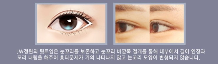 뒤트임 잘하는 병원! JW정원성형외과 뒷트임 성형 관련 이미지 5
