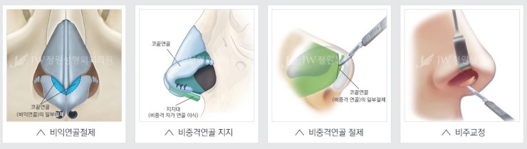 [JW정원성형외과] 코성형, 어려울수록 자신 있습니다! 관련 이미지 15