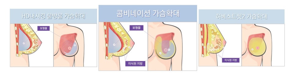 Combination Breast Augmentation: Achieving a More Natural Cleavage by Combining the Benefits of Implants and Fat Grafting image 3