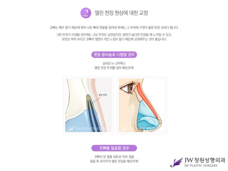 [JW정원성형외과] 매부리코성형, 매부리코성형 잘하는 곳에서 고민해결! 관련 이미지 5