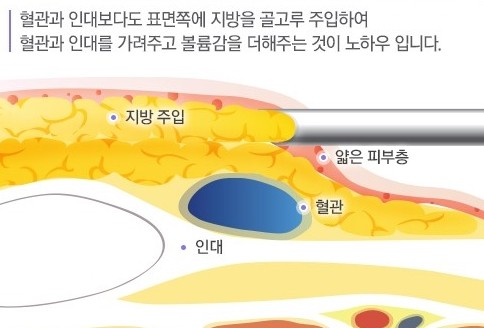 세월의 흔적을 감추는 매끈한 손등! JW정원성형외과 손등지방이식 관련 이미지 5