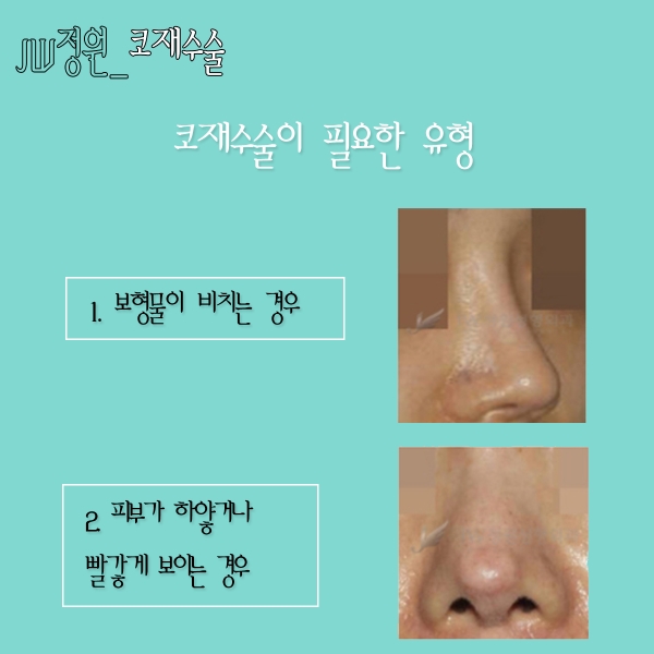 Nose revision surgery is definitely at JW Jeongwon Plastic Surgery! image 5