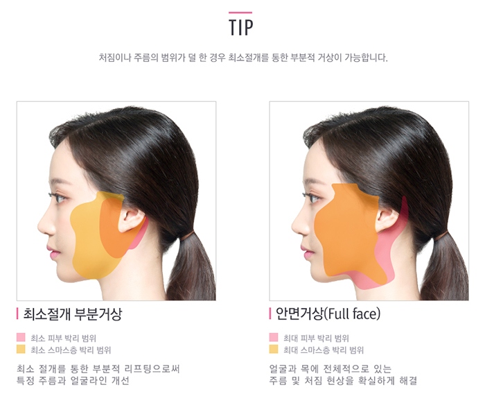 강력한 리프팅 효과로 동안 유지▷▶JW정원성형외과 스마스 조각 리프팅 관련 이미지 8