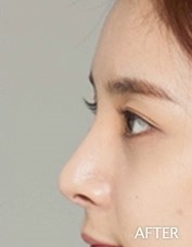 코재수술도 역시 JW정원성형외과 서만군원장 :] 관련 이미지 1