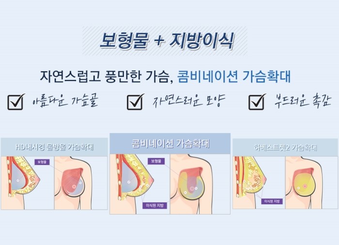 보형물+지방이식 장점만을 담은 JW정원성형외과 콤비네이션 가슴확대 관련 이미지 3