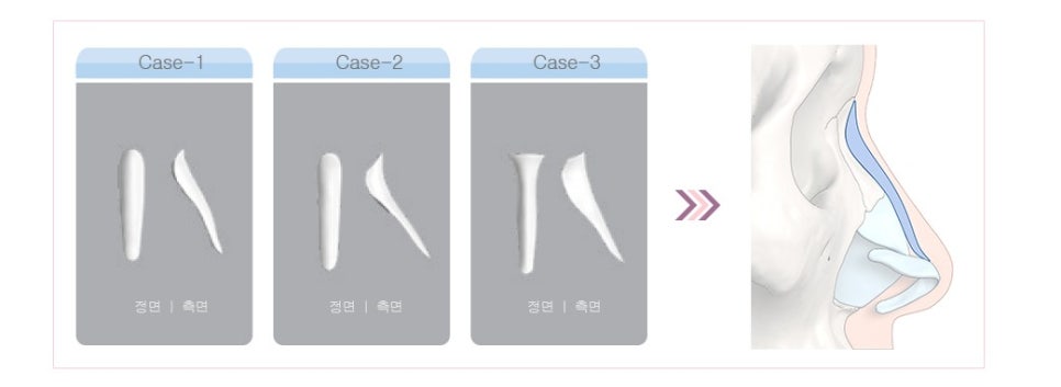 밋밋한 얼굴을 입체감 있는 얼굴로, 낮은코성형후기로 알아봐요 관련 이미지 4