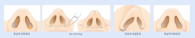 세련되고 아름다운 코라인! JW정원성형외과 복코교정으로 관련 이미지 7