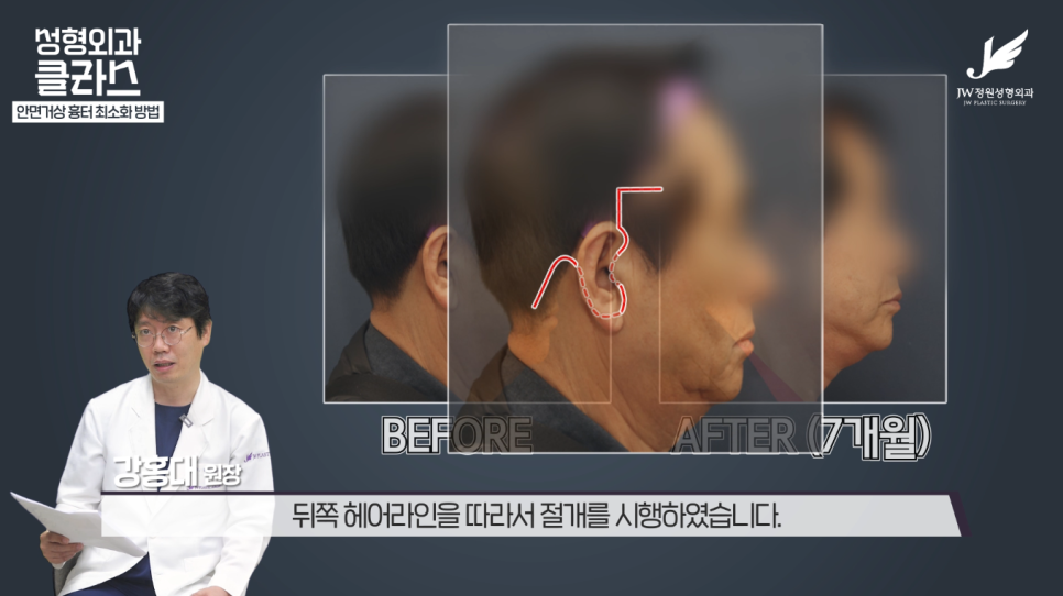 안면거상술후기 흉터 걱정 없이 깔끔하게!  【강남 JW정원성형외과】 관련 이미지 19