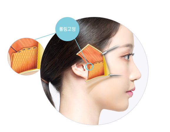 강력한 리프팅 효과로 동안 유지▷▶JW정원성형외과 스마스 조각 리프팅 관련 이미지 6
