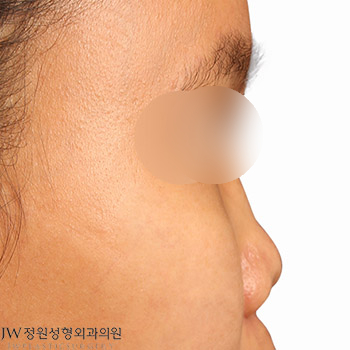 Silicone Side Effects: Safe and Beautiful Revision Rhinoplasty with Autologous Rib Cartilage! image 1