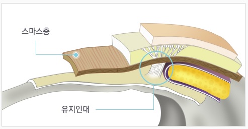 강력한 리프팅 효과로 동안 유지▷▶JW정원성형외과 스마스 조각 리프팅 관련 이미지 5