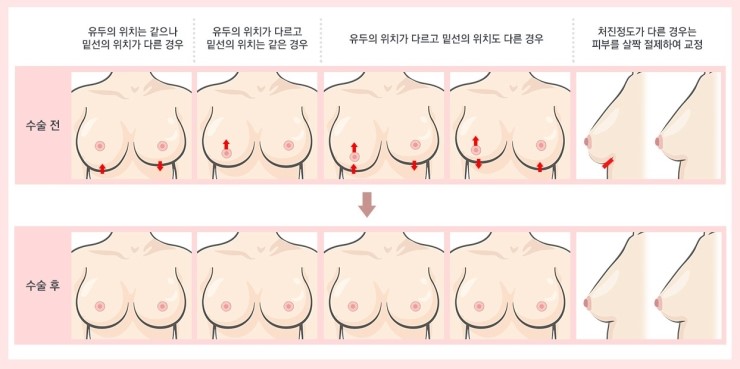 출산과 다이어트로 처진 가슴! JW정원성형외과 처짐교정 확대술! 관련 이미지 7