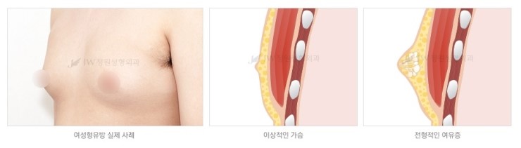 불룩한 가슴으로 고민이라면? 여성형유방(여유증) 성형도 역시 JW정원성형외과! 관련 이미지 2