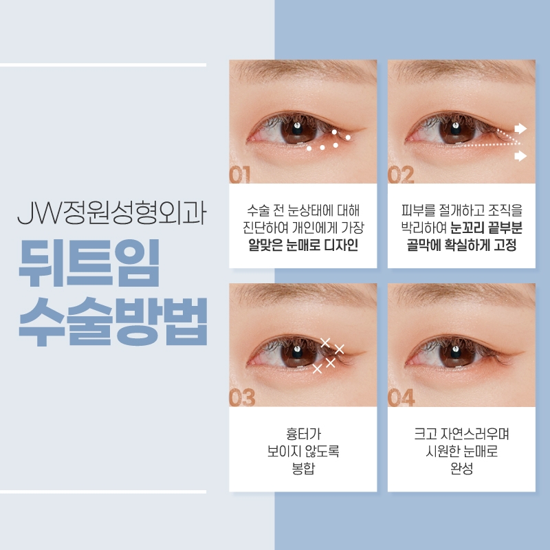 Carefully Check the Cost of Lateral Canthoplasty image 5
