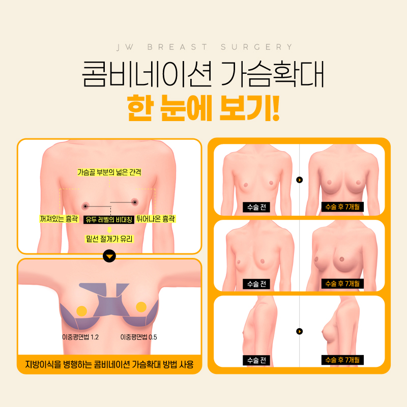 가슴성형병원 콤비네이션으로 볼륨 있게 관련 이미지 2