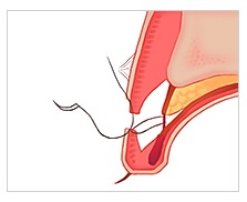 눈재수술! 병원선택부터 신중하게! JW정원성형외과 쌍꺼풀 재수술 관련 이미지 6