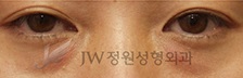 밝고 맑은 인상으로 변신, 눈밑지방재배치! JW정원성형외과에서~ 관련 이미지 1