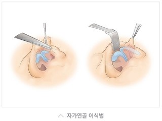 돼지코 탈출▷▶JW정원성형외과 들창코, 짧은코 교정 관련 이미지 6