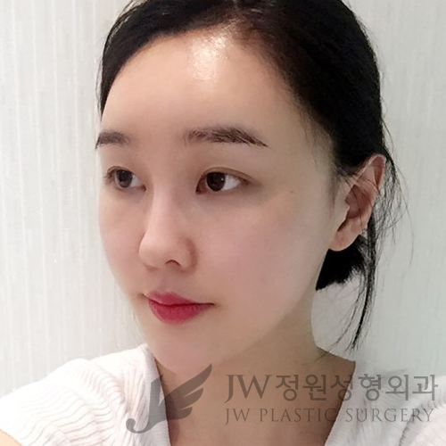 이마눈썹리프팅,눈매교정술,앞트임복원,코성형,지방이식 &rArr; JW정원성형외과에서! 관련 이미지 6