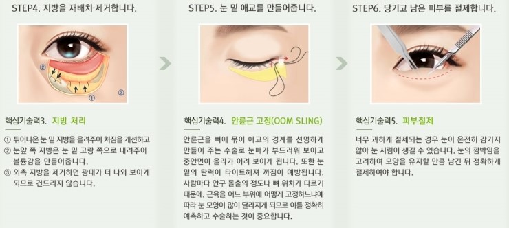 Three-Dimensional Under-Eye Contours Can Be Restored to How They Looked 10 Years Ago with Lower Blepharoplasty image 7