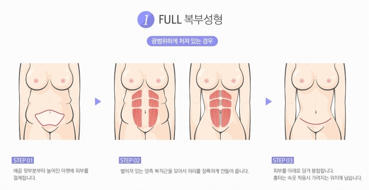 처지고 늘어진 뱃살 탈출! 완벽 S라인으로 변신 JW정원 복부성형 관련 이미지 3