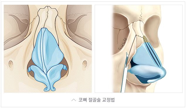 휜코교정 근본적인 미용/기능 개선(코막힘, 비염, 두통 등) 관련 이미지 5