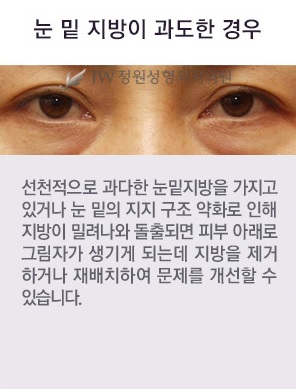 울퉁불퉁한 눈 밑, 피곤해 보이는 눈 밑 JW정원 눈밑지방재배치로 고민 해결! 관련 이미지 1