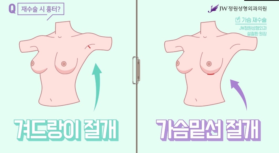 Breast Revision Surgery: Worried About Additional Scarring? image 4