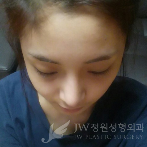 코재수술도 역시 JW정원성형외과 서만군원장 :] 관련 이미지 5