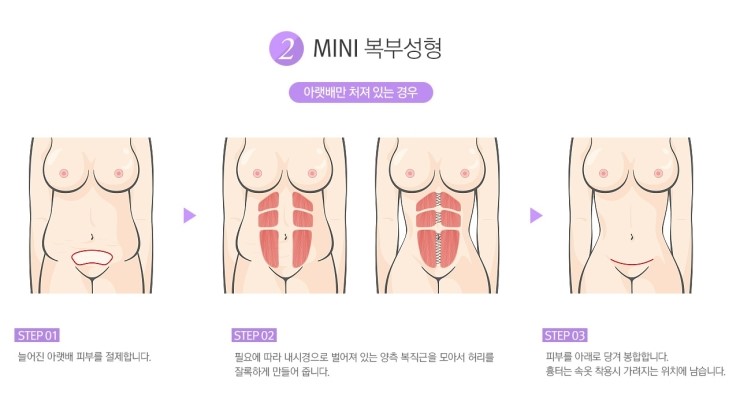 처지고 늘어진 뱃살 탈출! 완벽 S라인으로 변신 JW정원 복부성형 관련 이미지 4