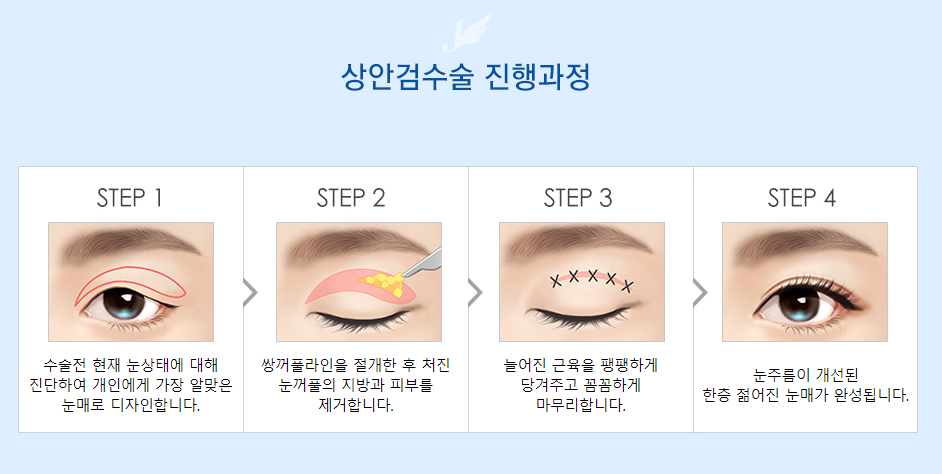 Achieve a More Youthful, Taut Eye Shape with Upper Blepharoplasty! (Eyelid Sagging Surgery) image 4