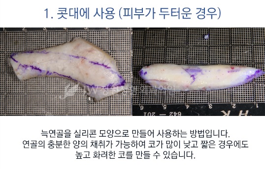 [JW정원성형외과] 코성형, 어려울수록 자신 있습니다! 관련 이미지 4