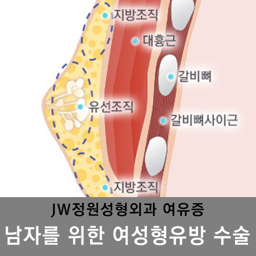[JW정원성형외과]여유증, 여성형유방 수술로 해결하세요! 관련 이미지 8